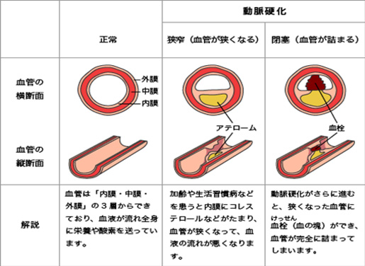 動脈硬化について