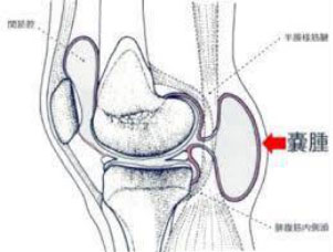 ベーカー嚢腫とは