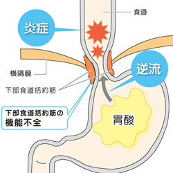 が 薬 性 ない 炎 効か 食道 逆流