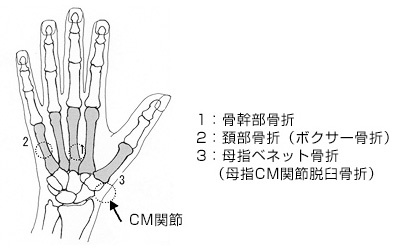 中手骨 手のひら 甲 骨折の治療と検査 健診会 滝野川メディカルクリニック