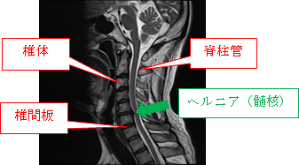 の ヘルニア 首