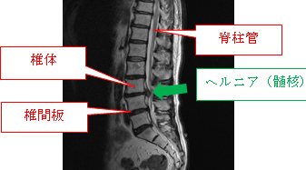 腰椎椎間板ヘルニアの治療と検査について 健診会 滝野川メディカルクリニック