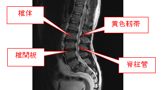 狭窄 腰椎 脊柱 症 管