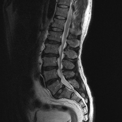 腰椎脊柱管狭窄症の治療と検査 健診会 滝野川メディカルクリニック